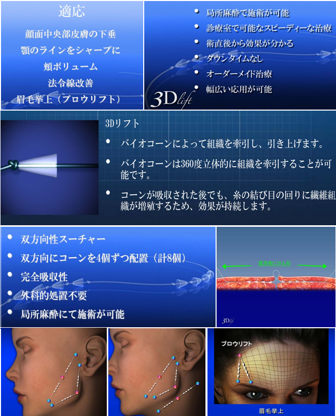 3Dリフト(シルエットリフト)