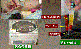 マイセルACR＜PRP再生医療＞
