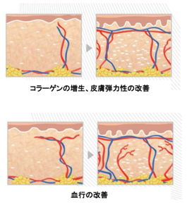 PLLAスクリュースレッドリフトとは？