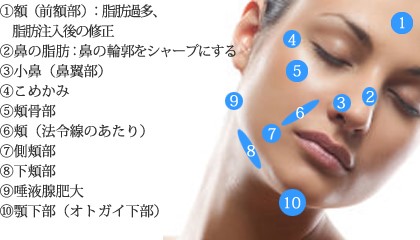 輪郭注射（フェイスダイエット）｜大阪で顔のたるみやセルライト減少